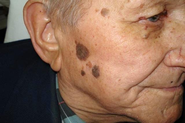  В пожилом возрасте часто возникают кератомы кожи и грибковая инфекция ногтей Фото: http://med.msk.acoola.ru/ 